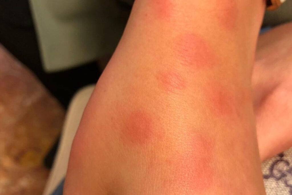 infestation de punaises